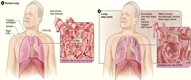 Chronic Obstructive Pulmonary Disease (COPD)