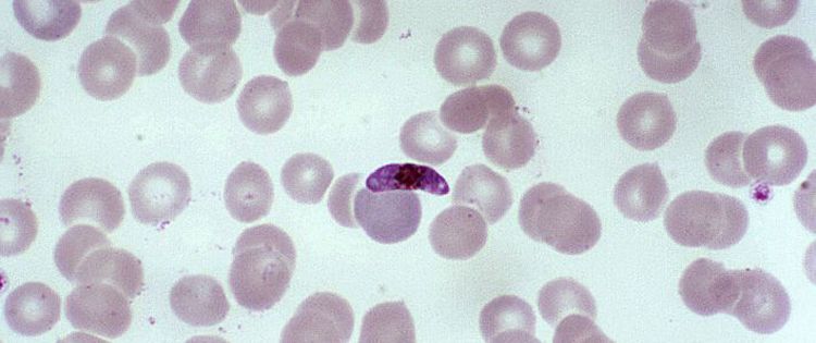 P. Falciparum parasite is often the cause of the most deadly manifestations of Malaria.