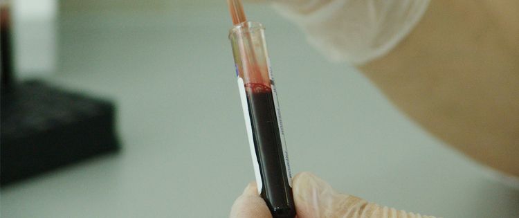 Blood sample is required to identify the presence and species of parasitic infection through the use of a rapid diagnostic test (RDT)