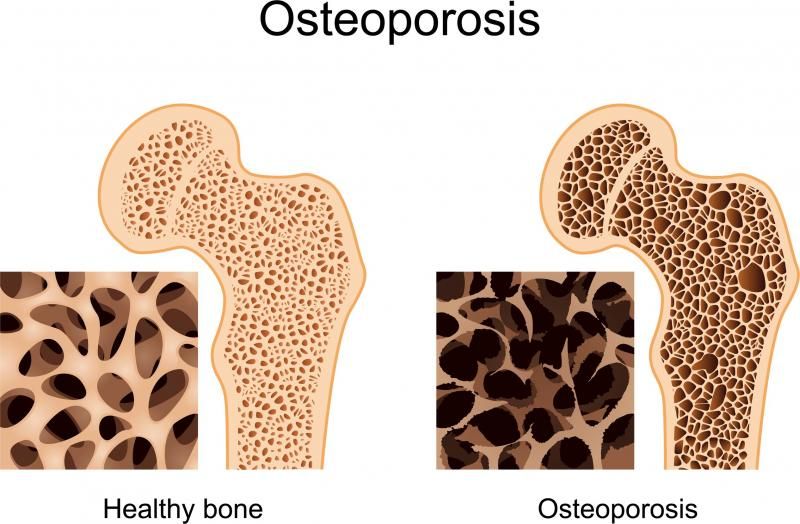 Cannabis to Bone Health