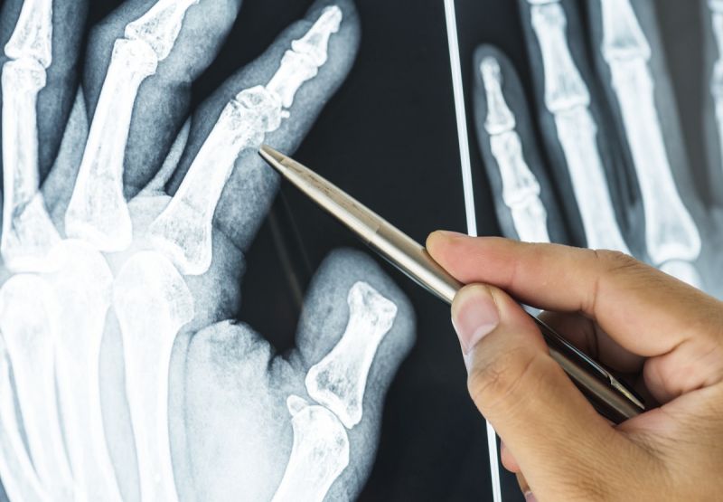 x-ray of finger joints - conditions CBD target