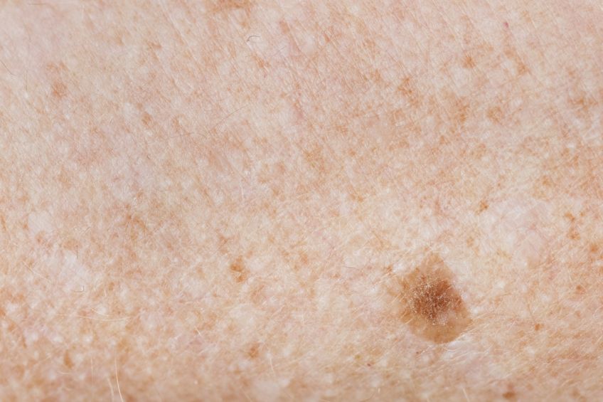 freckled skin / skin cancer